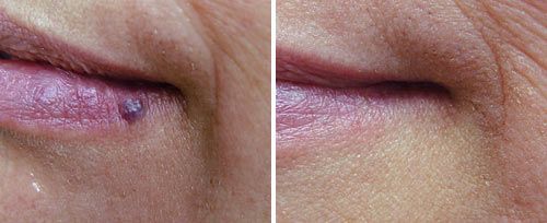 real patient before and after treatment with Fotona laser
