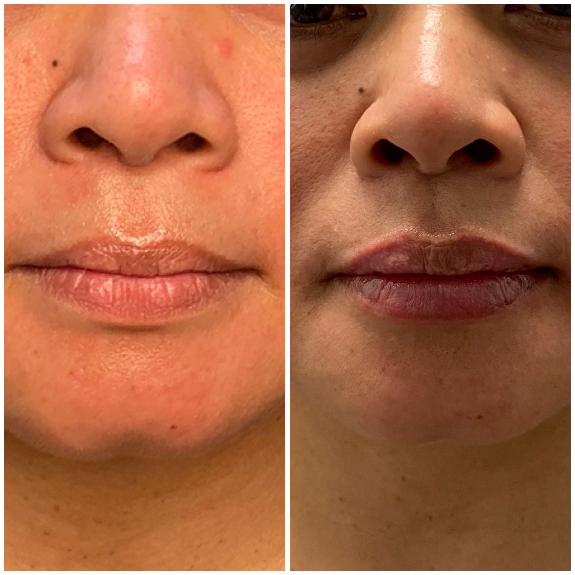 patient photos: lip fillers before and after