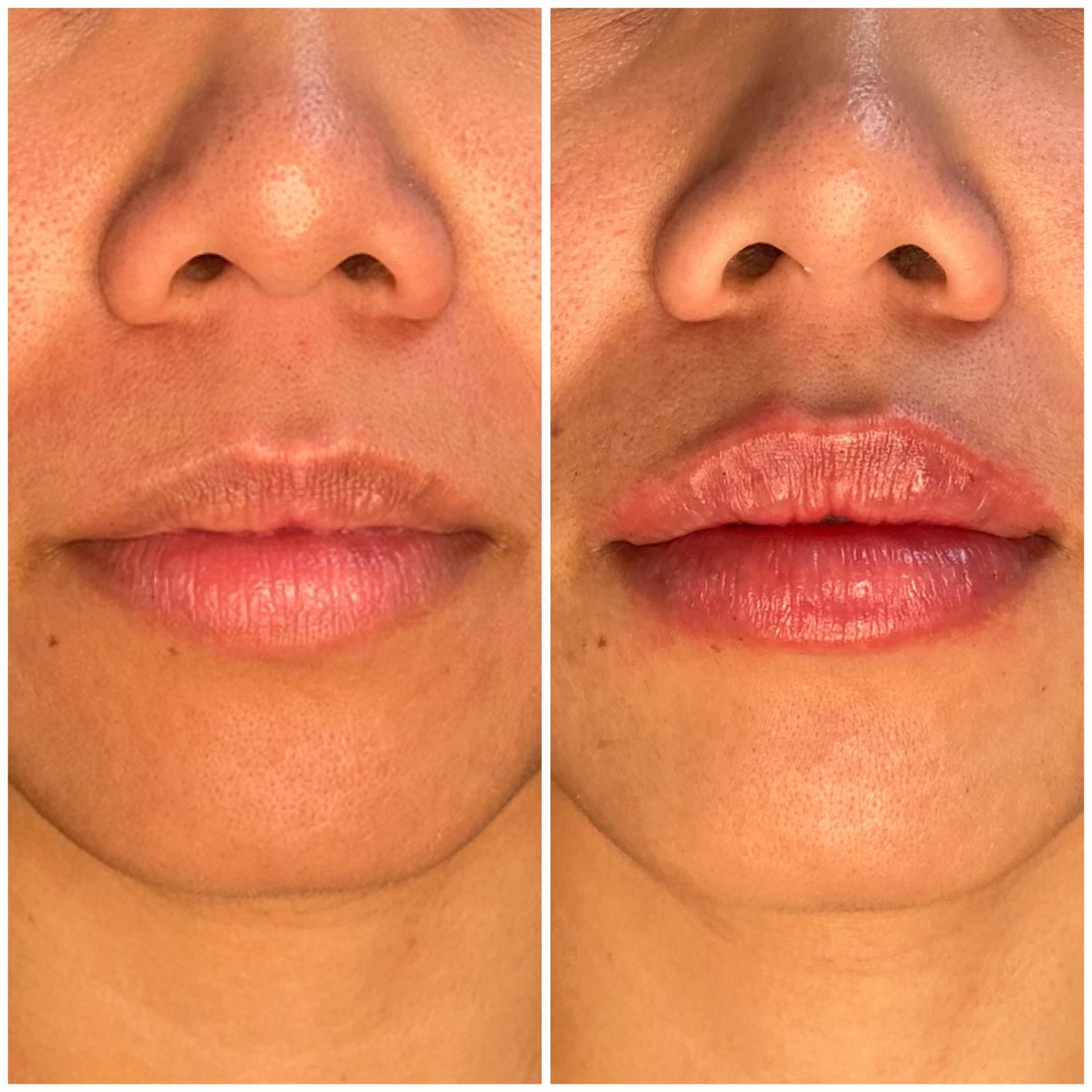 patient photos: lip fillers before and after