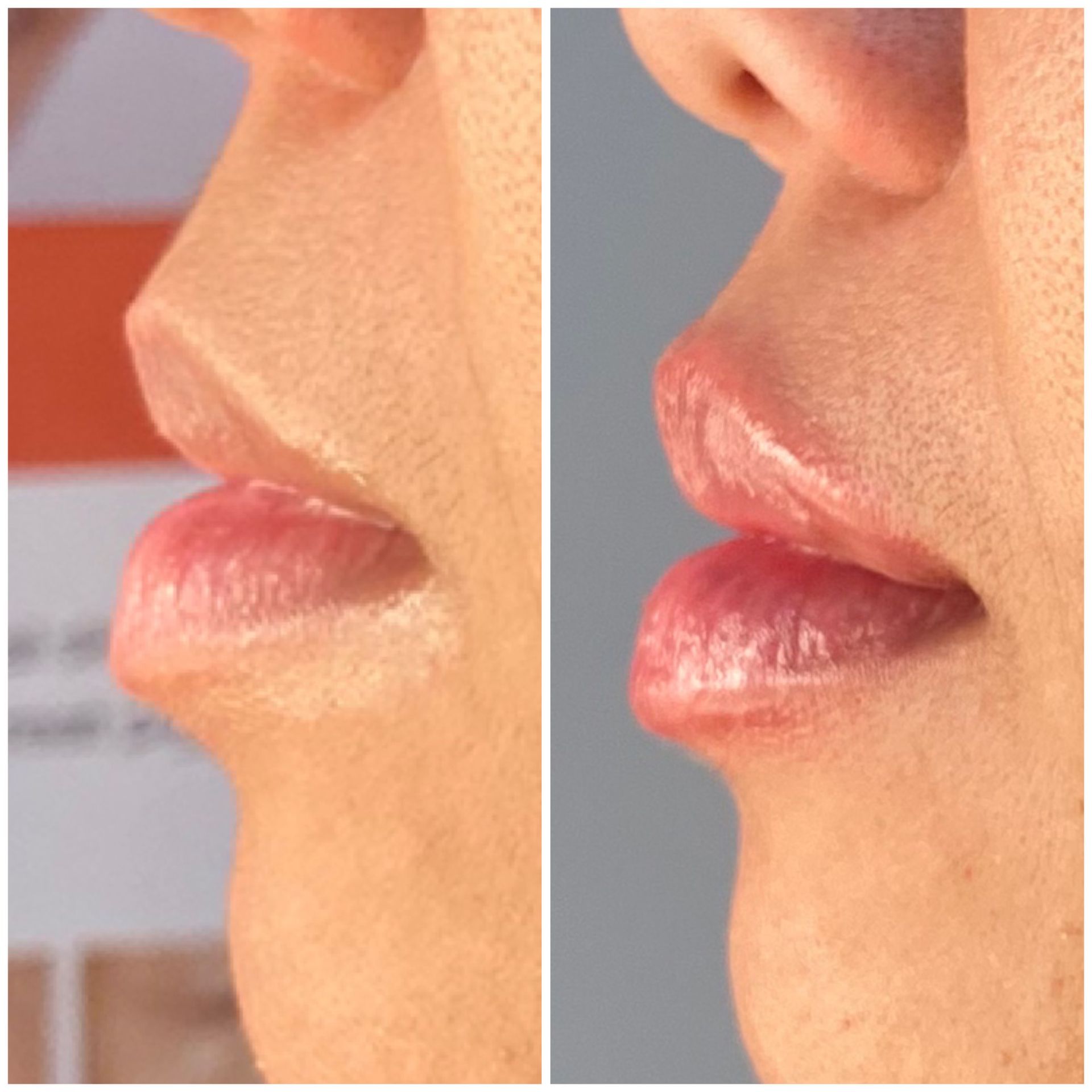 patient photos: lip fillers before and after