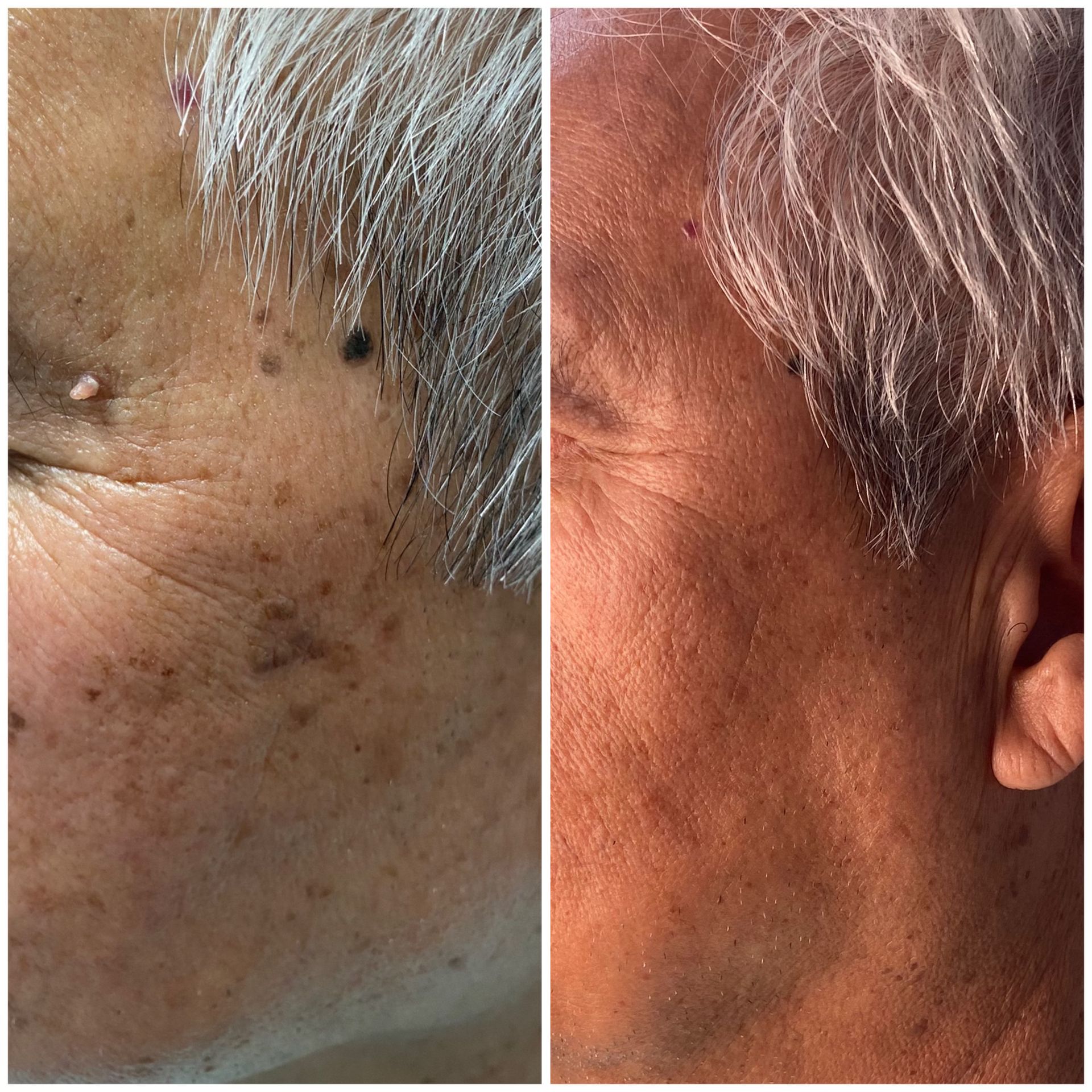 patient photo - BENIGN SKIN LESION REMOVAL