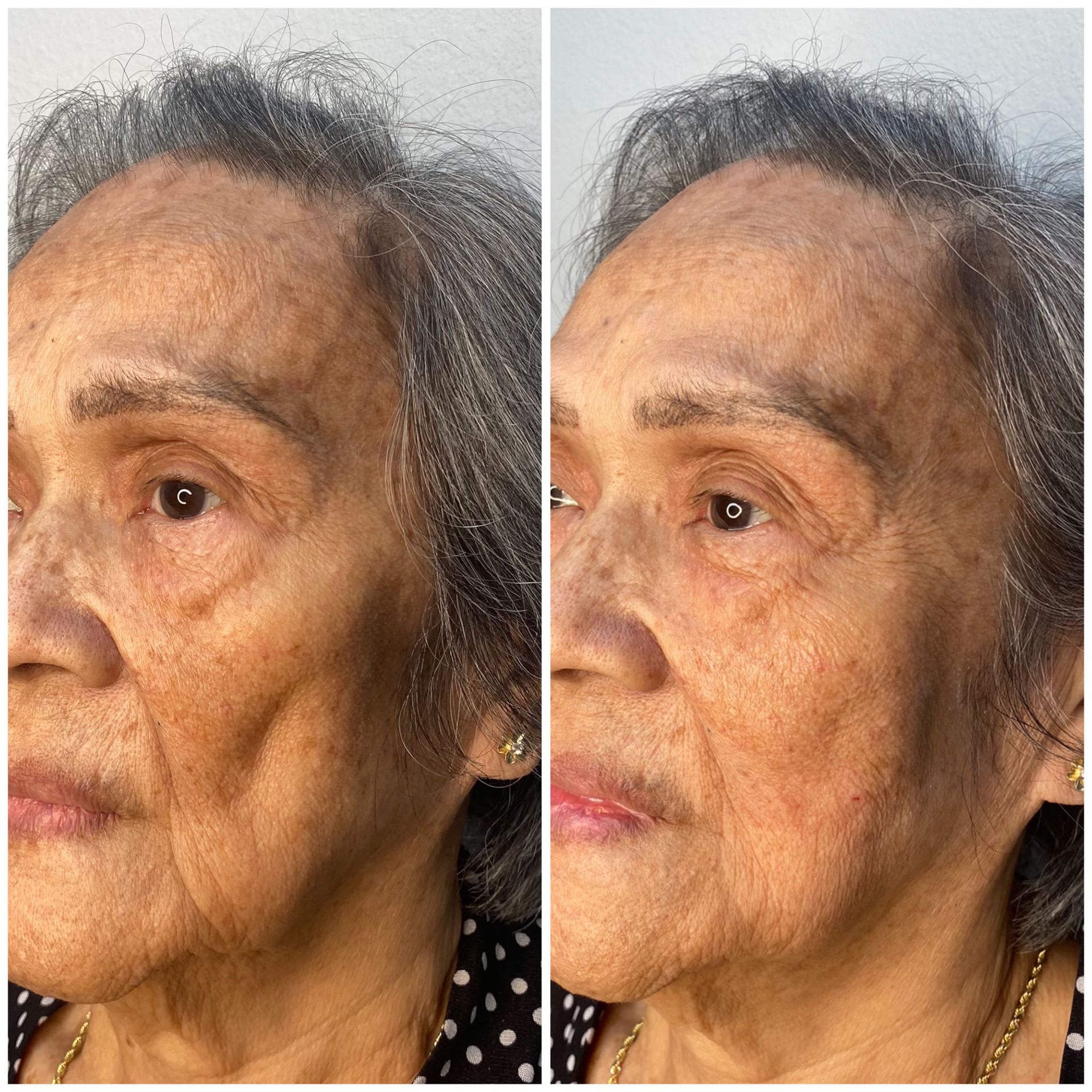 patient photo - BENIGN SKIN LESION REMOVAL