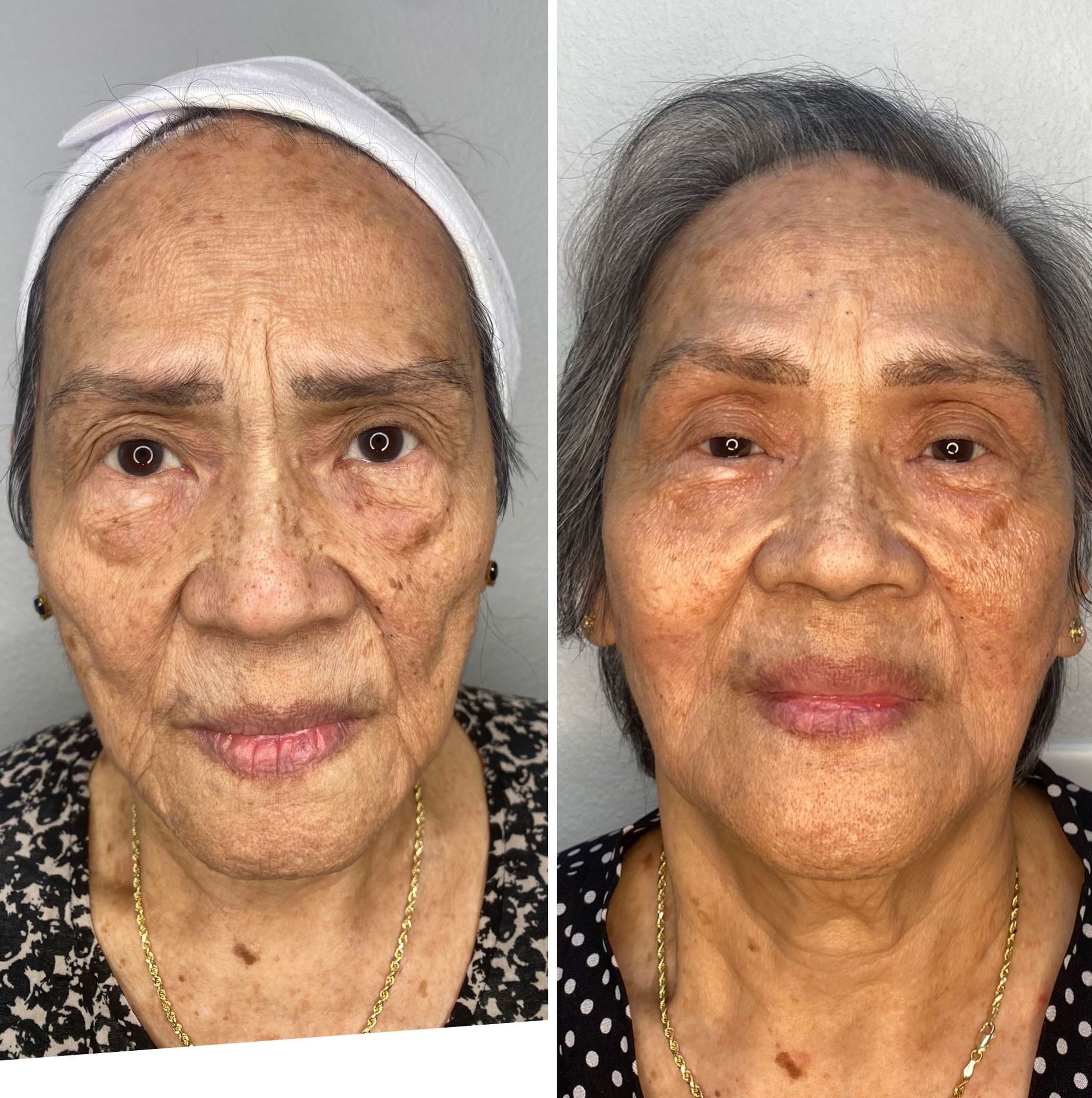 PATIENT PHOTO COMBINATION TREATMENTS ON 80 YO FEMALE (FACE THREAD, CHEEK FILLER, FILLERS ON CHEEK HALLOWS AND LIP FILLER)