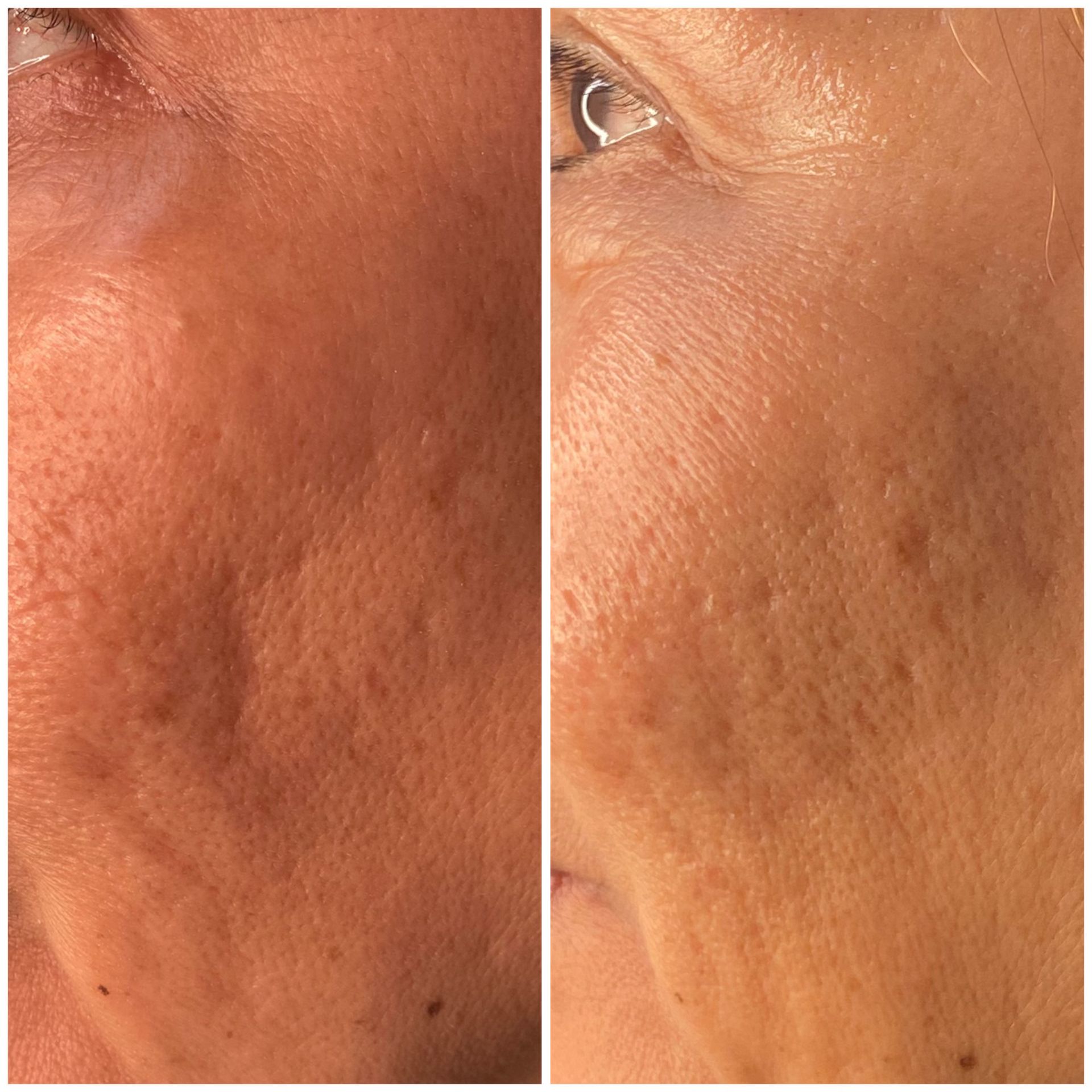 PATIENT PHOTO ACNE SCAR REVISION WITH SUBSCISION AND BELLAFIL - 1 TREATMENT