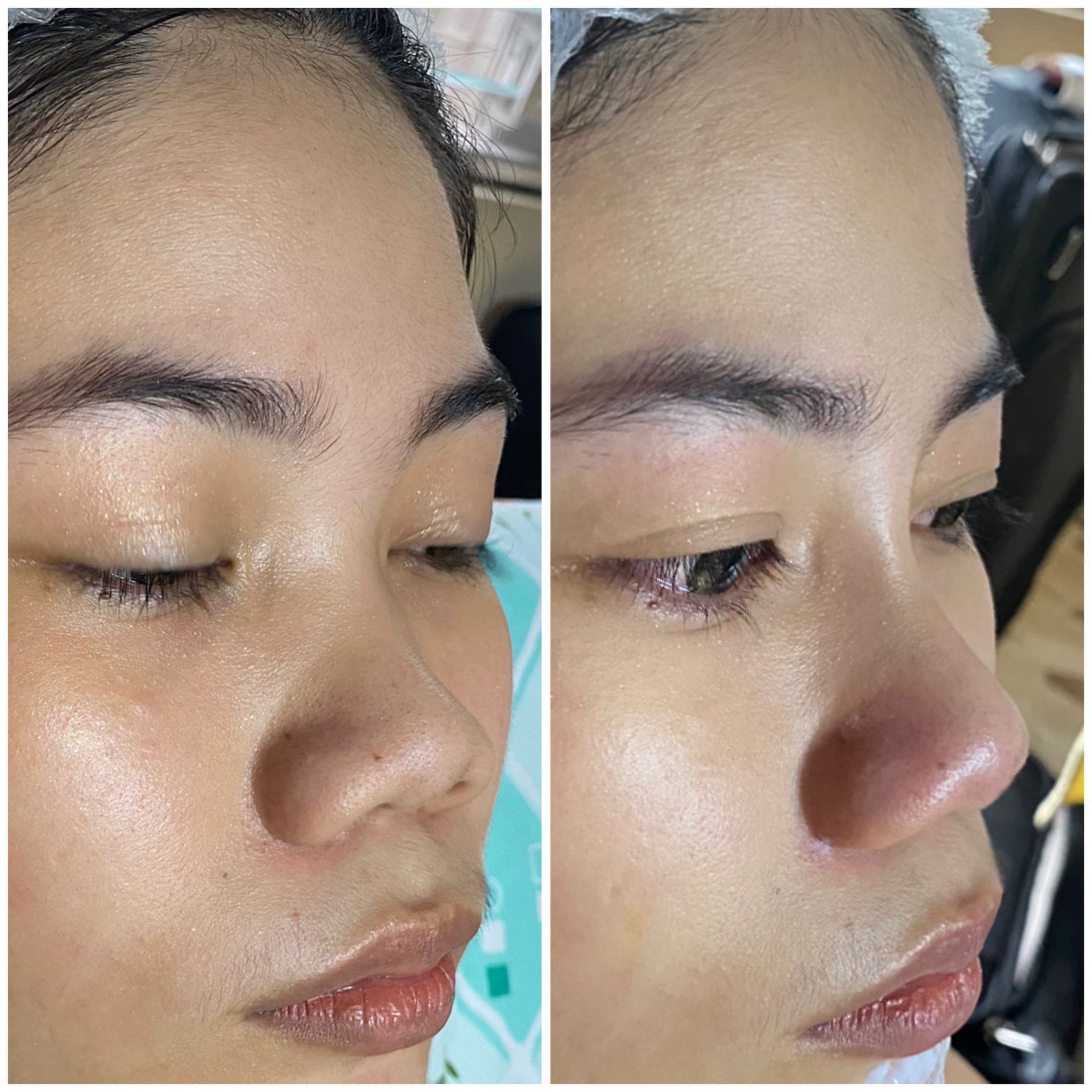 PATIENT PHOTO NOSE FILLER