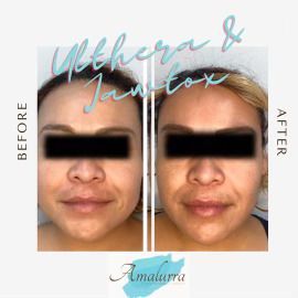 PATIENT PHOTO FACIAL CONTOURING WITH ULTHERA AND JAWTOX AFTER 2 MONTHS