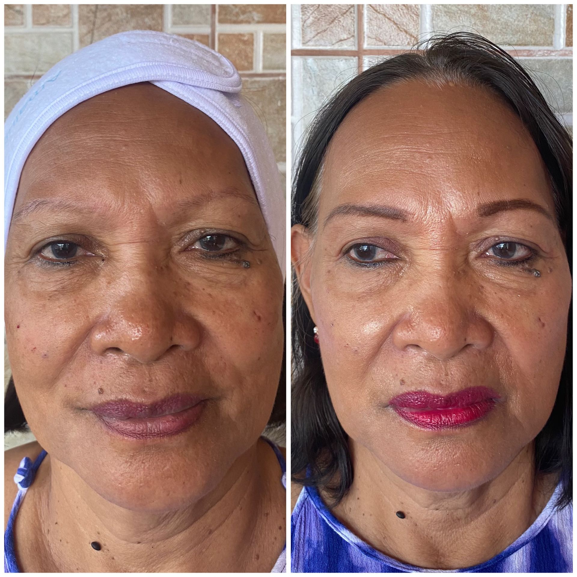 patient photo - CHEEK AND NASOLABIAL FOLD FILLER