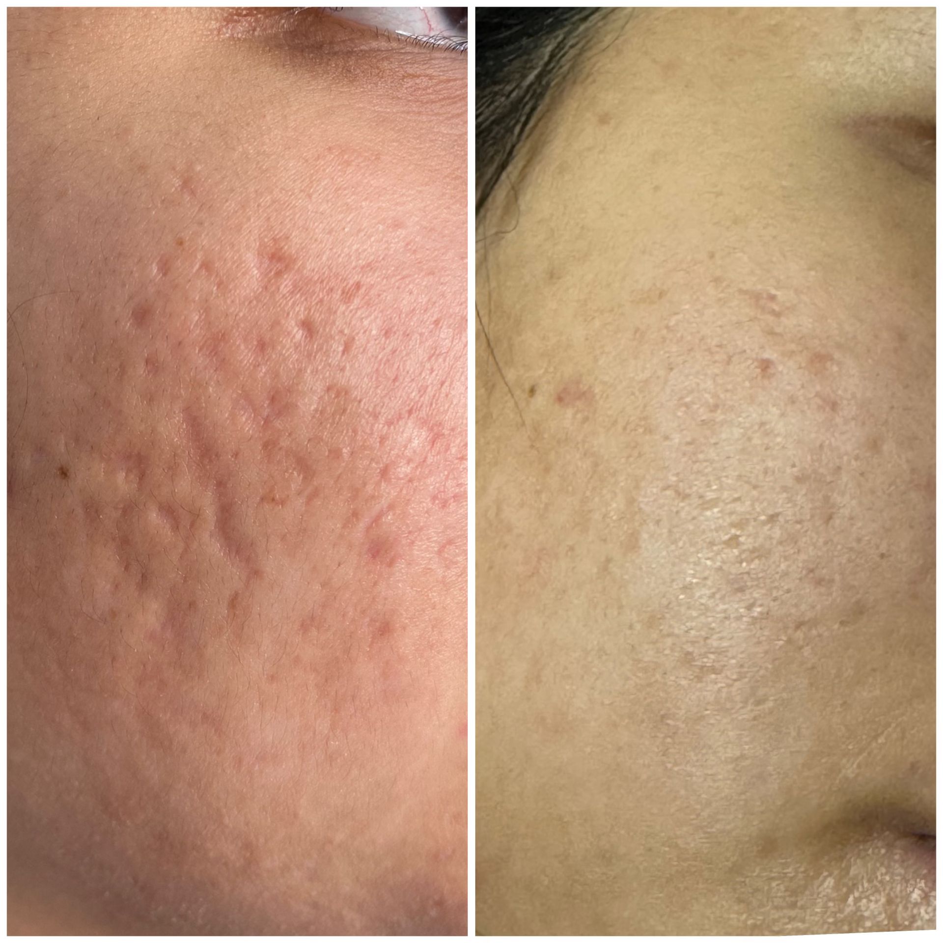 patient photo - ACNE SCAR REVISION WITH SUBSCISION AND BELLAFIL - 1 TREATMENT