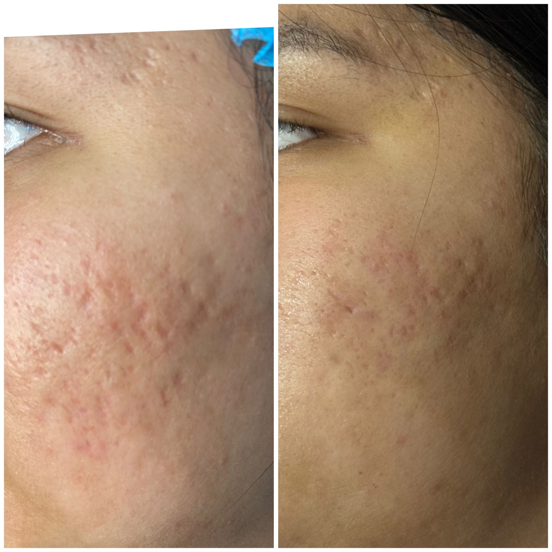 patient photo - ACNE SCAR REVISION WITH SUBSCISION AND BELLAFIL - 1 TREATMENT