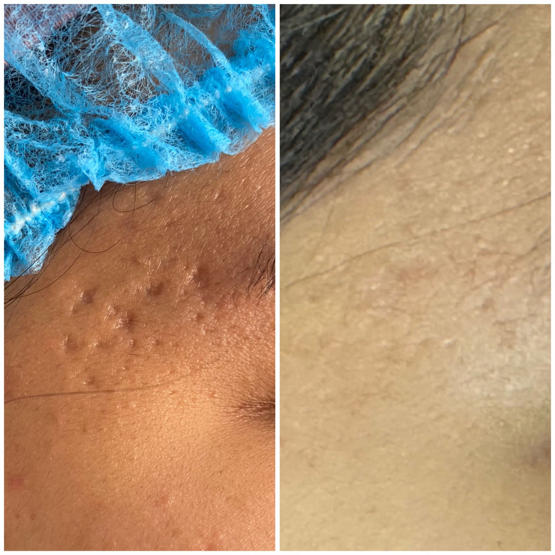 patient photo - ACNE SCAR REVISION WITH SUBSCISION AND BELLAFIL - 1 TREATMENT