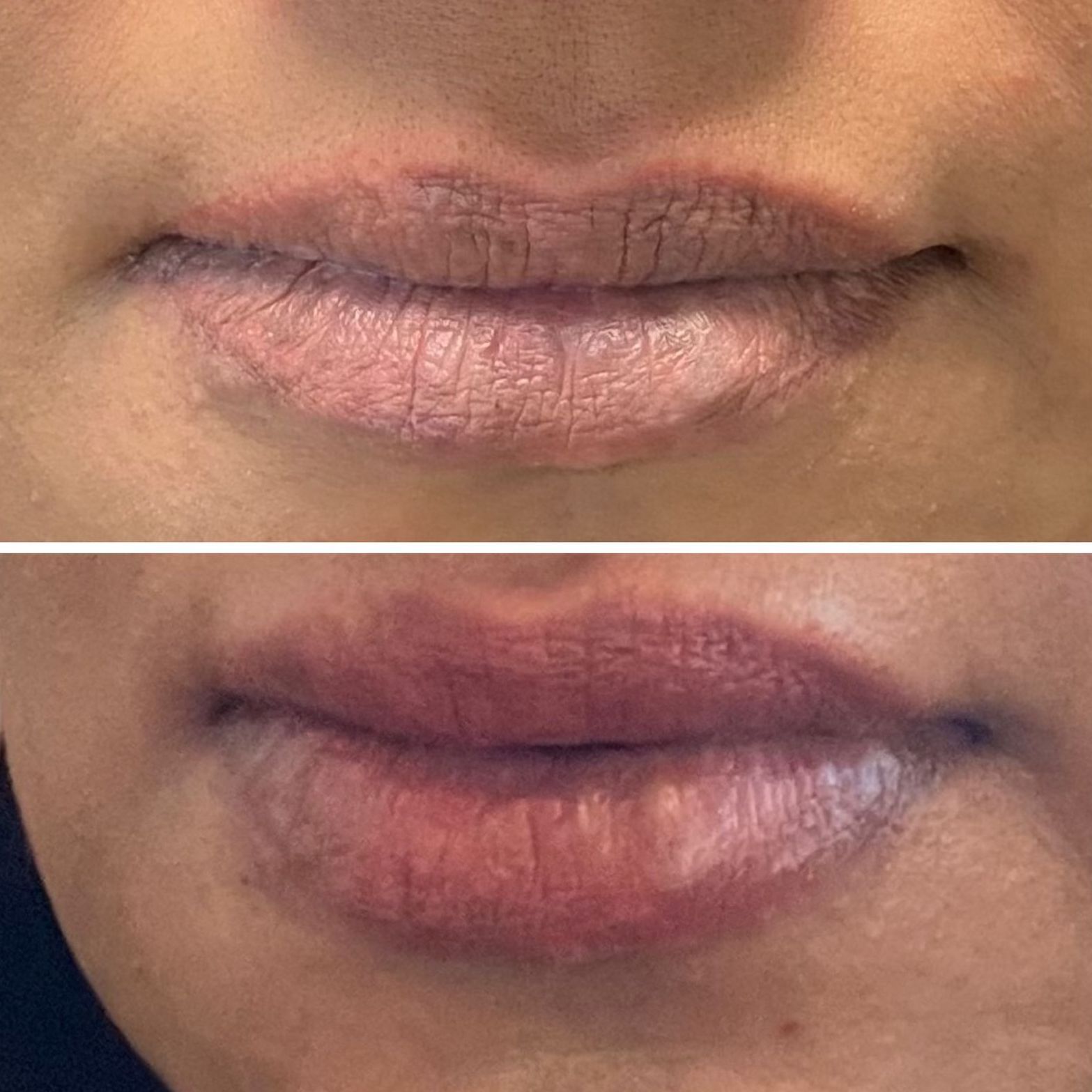 patient photos: lip fillers before and after