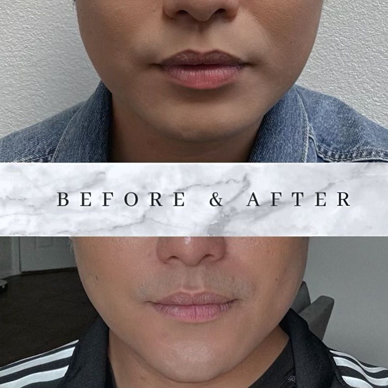 PATIENT PHOTO CHEEK FILLER