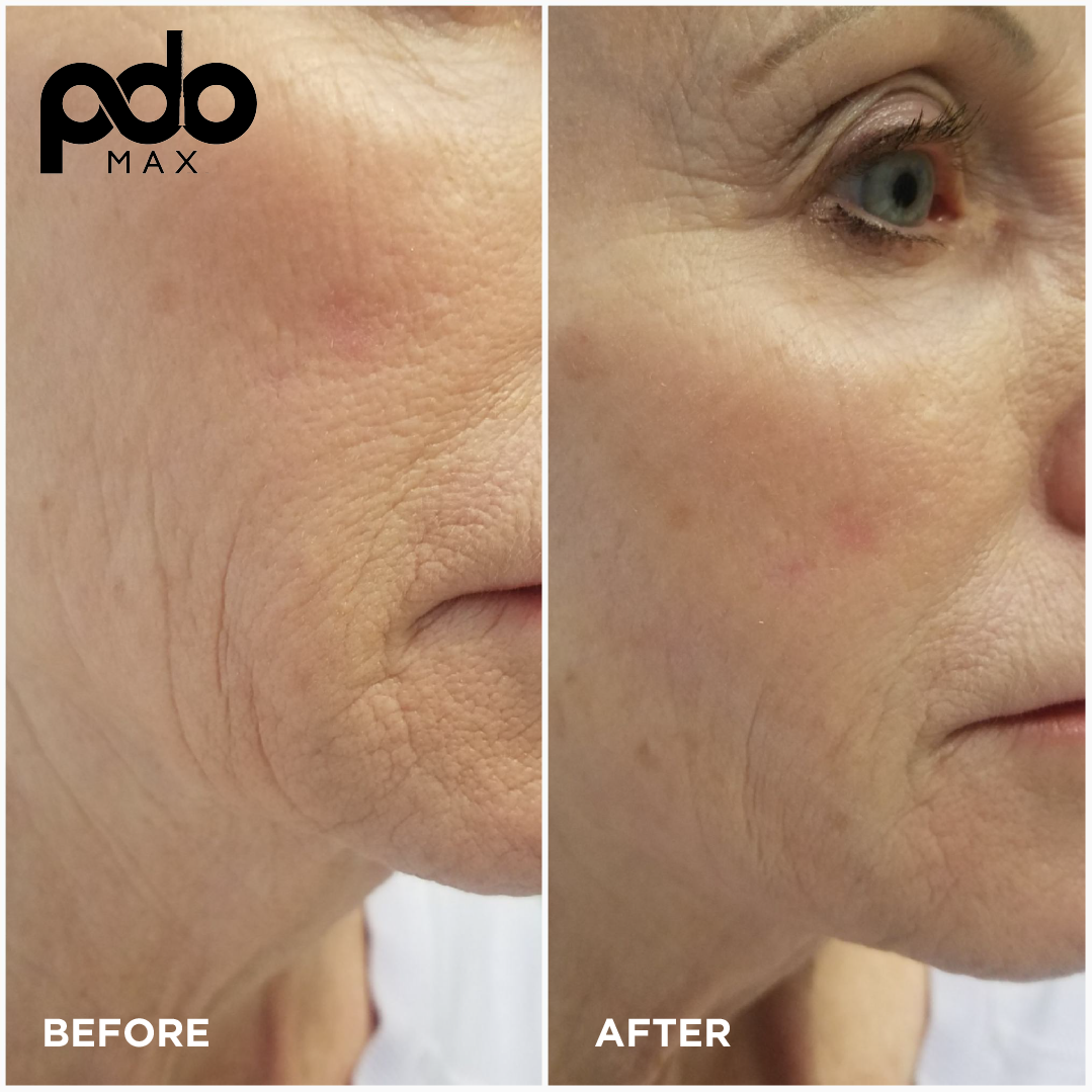 real patient shown before and after treatment with PDO Max threads