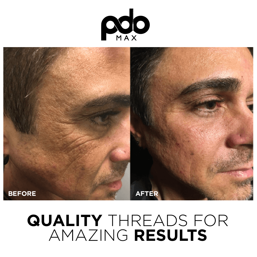 real patient shown before and after treatment with PDO Max threads