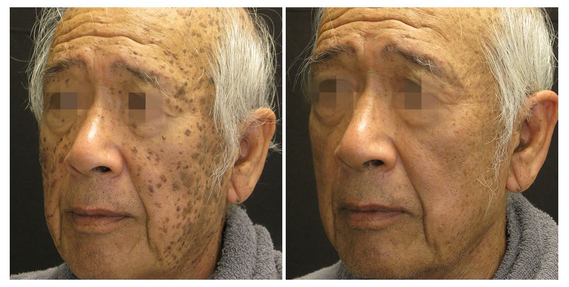 patient before and after treatment with PicoSure Pro laser for melasma and hyperpigmentation