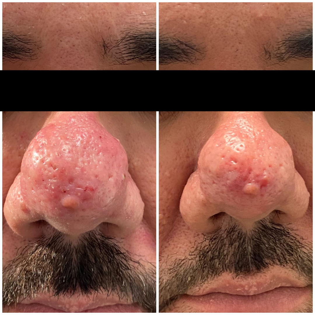 PATIENT PHOTO RHINOPYMA AFTER 1 TREATMENT OF FOTONA ACNE - ROSACEA LASER