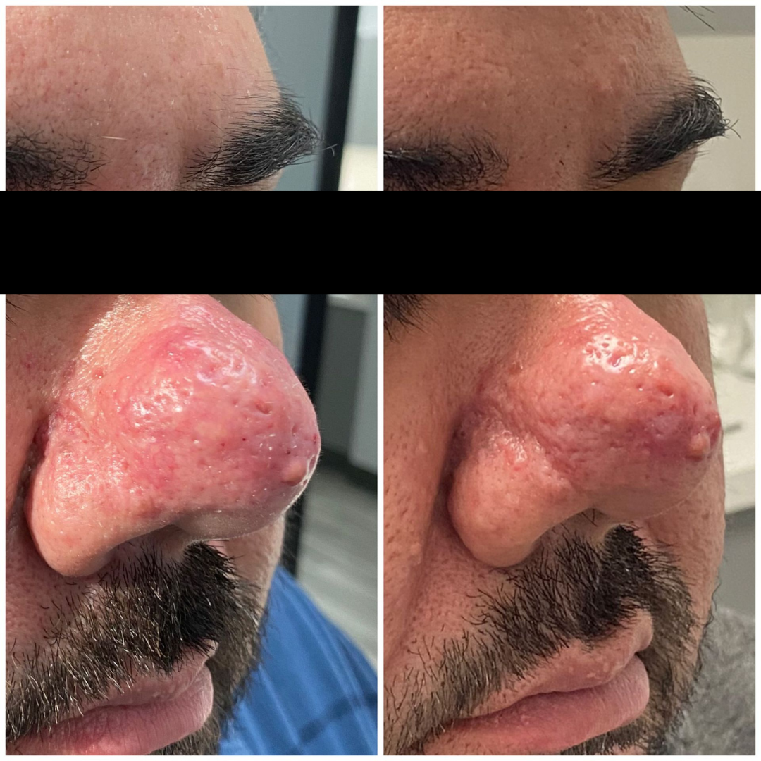 PATIENT PHOTO RHINOPYMA AFTER 1 TREATMENT OF FOTONA ACNE - ROSACEA LASER