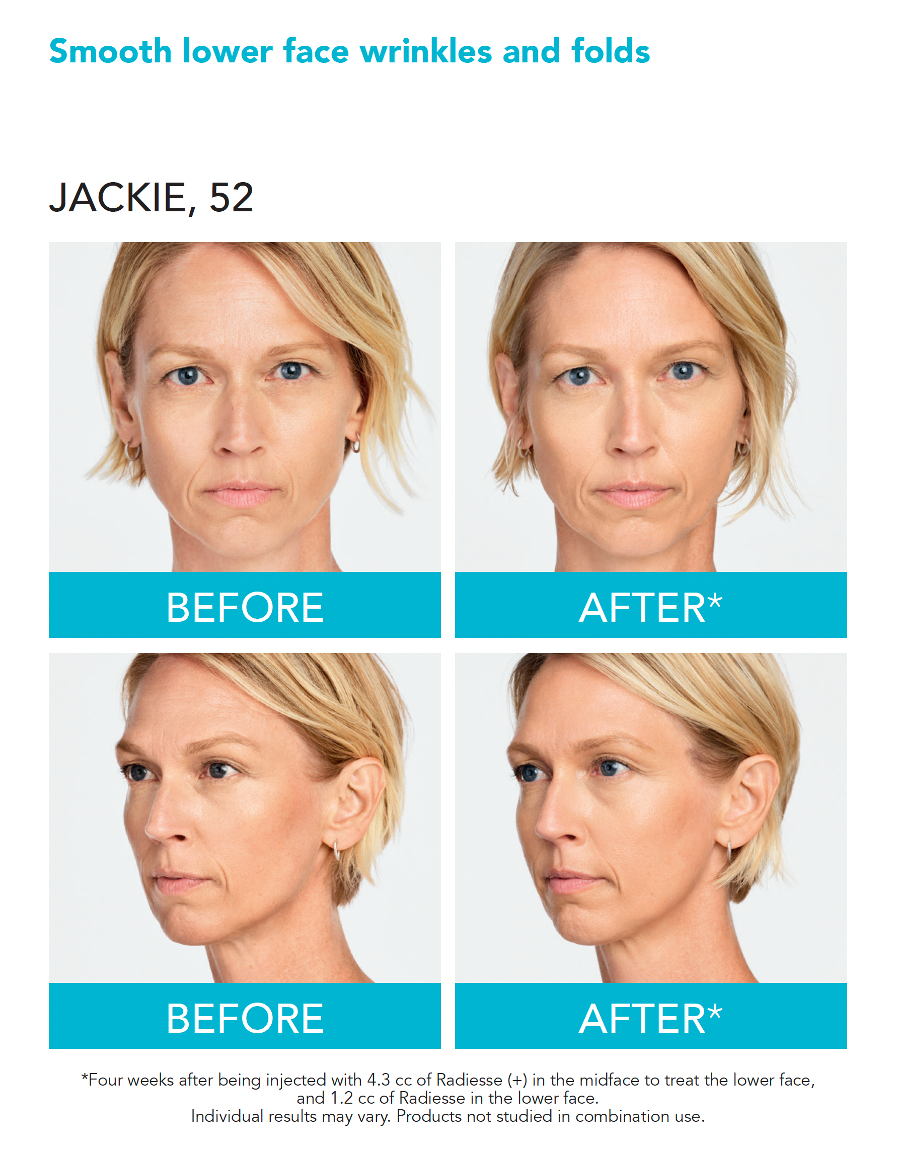 real patient shown before and after treatment with Radiesse