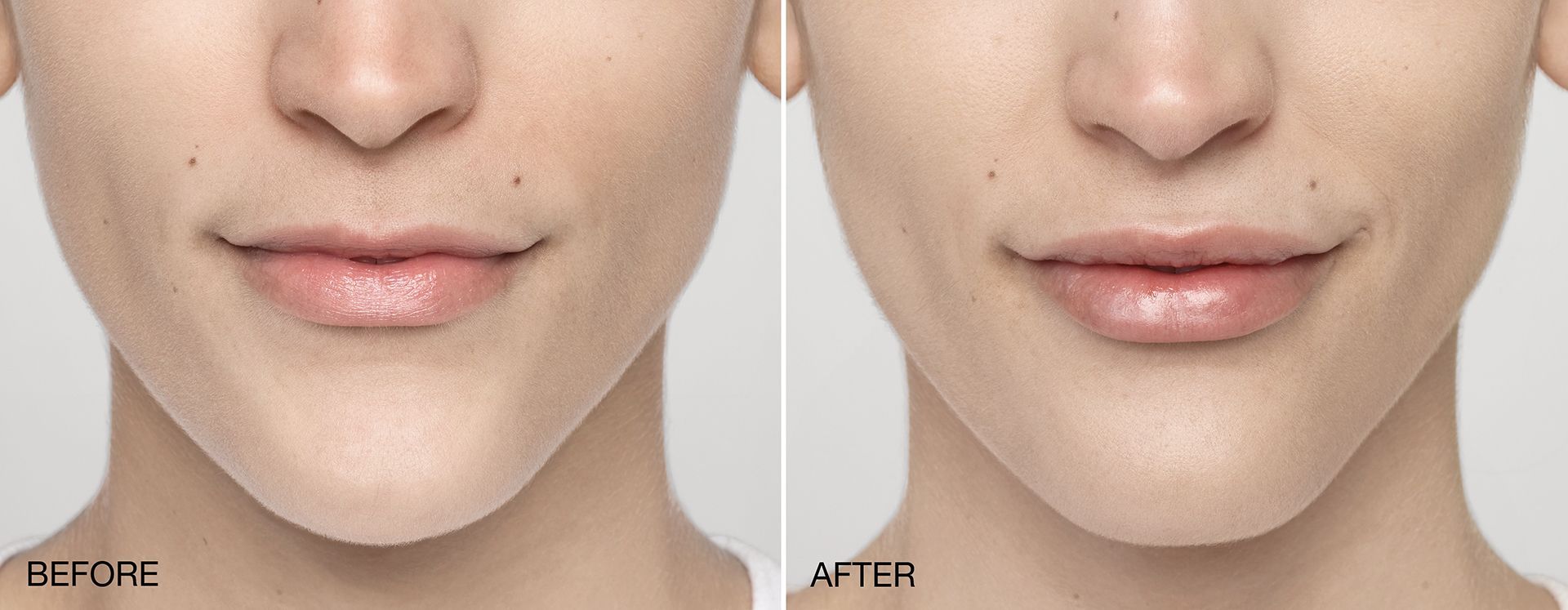 real patient shown before and after treatment with Restylane collection of fillers