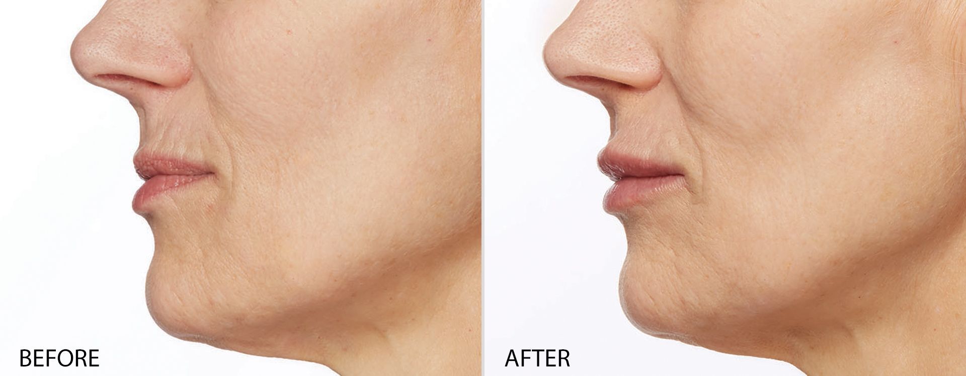 real patient shown before and after treatment with Restylane collection of fillers