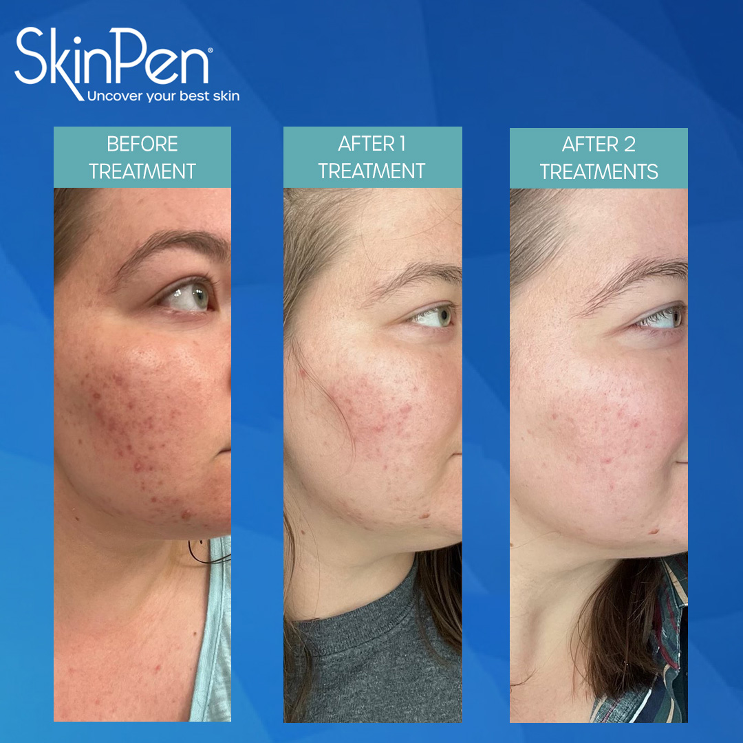 real patient shown before and after treatment with SkinPen®