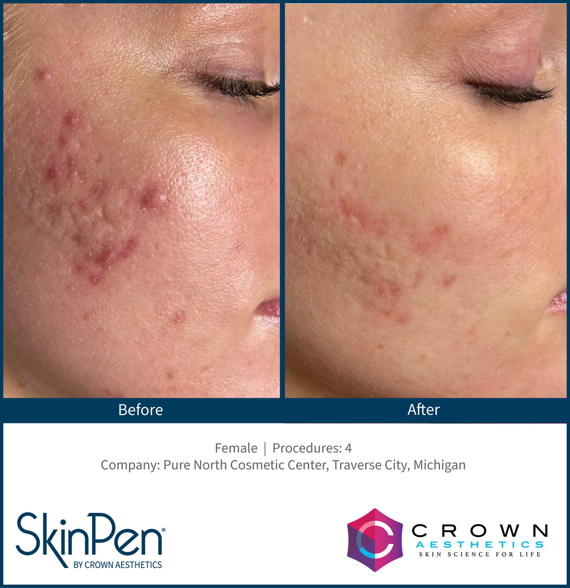 real patient shown before and after treatment with SkinPen®