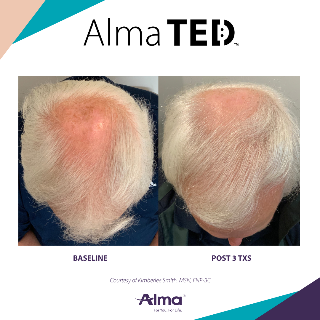 A man 's head is shown before and after alma ted treatment