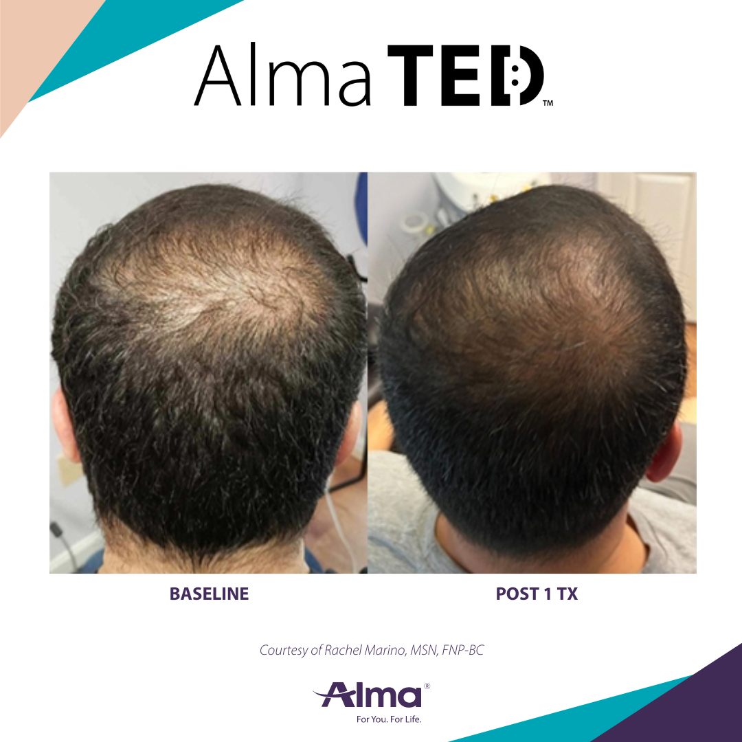 A picture of a man 's hair before and after alma ted treatment