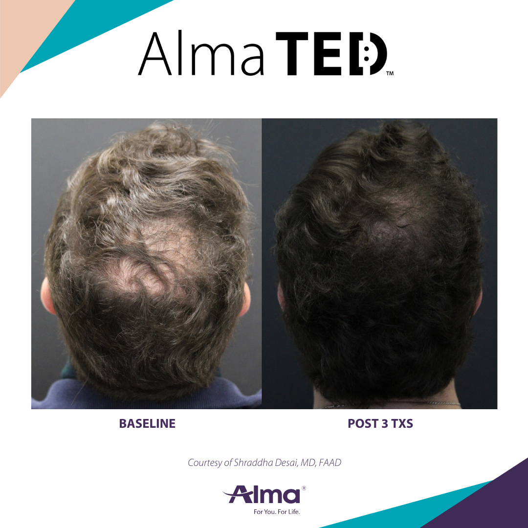 A picture of a man 's hair before and after alma ted treatment