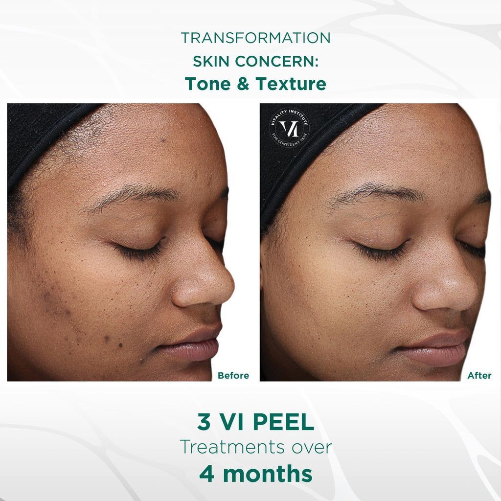 real patient shown before and after treatment with VI Peel