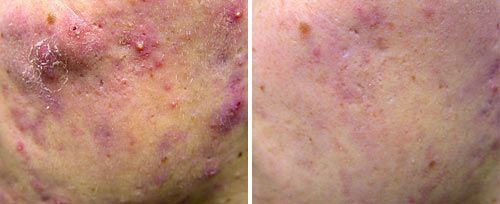 A before and after photo of a person 's face with acne.