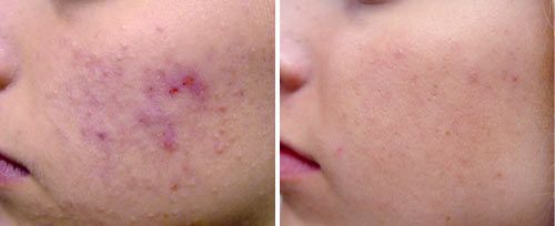 A before and after photo of a person 's face with acne.