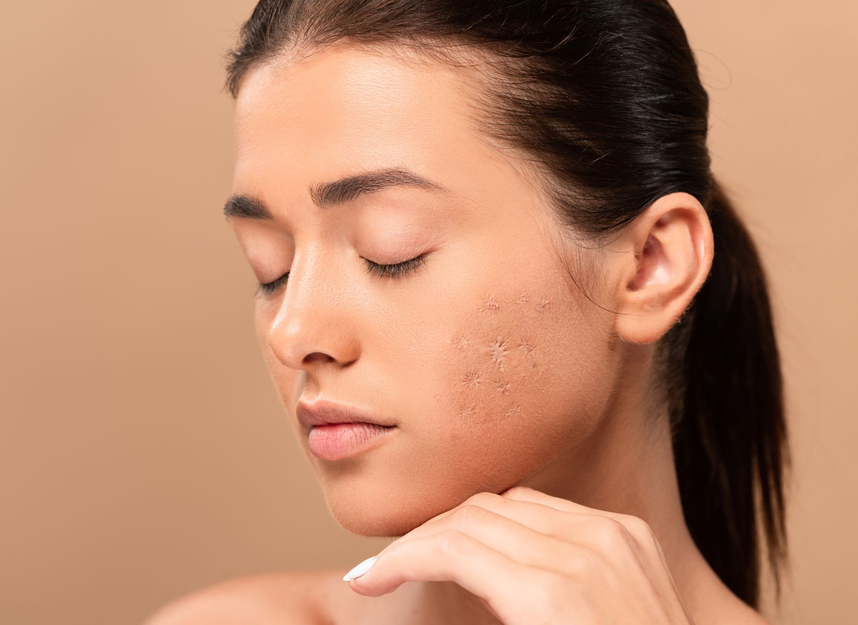 woman skincare model showing acne scarring on cheek