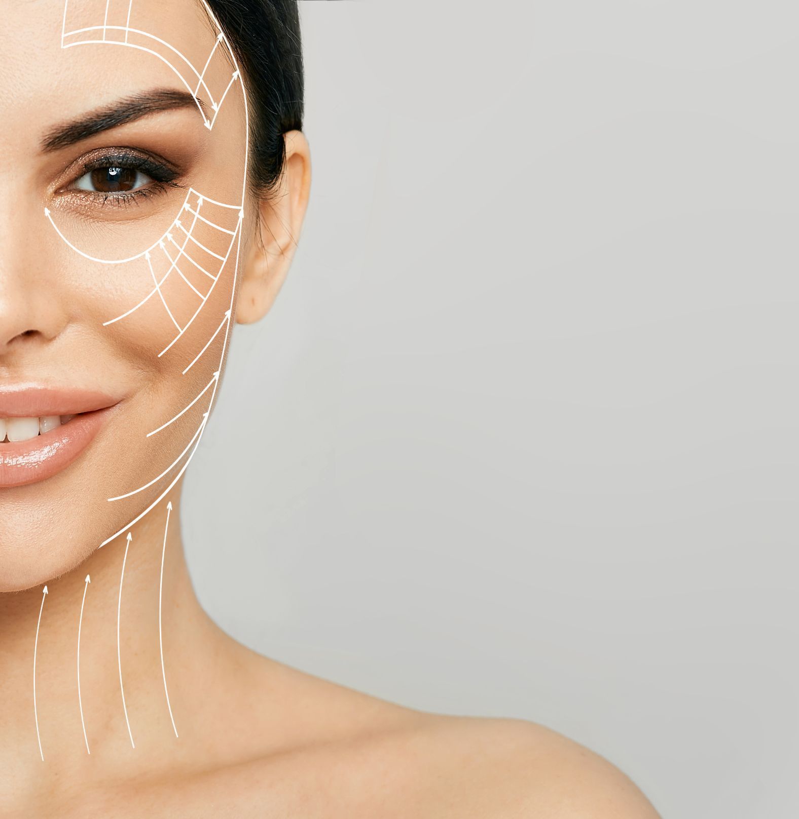 female model with lines over face showing example thread map for threadlift