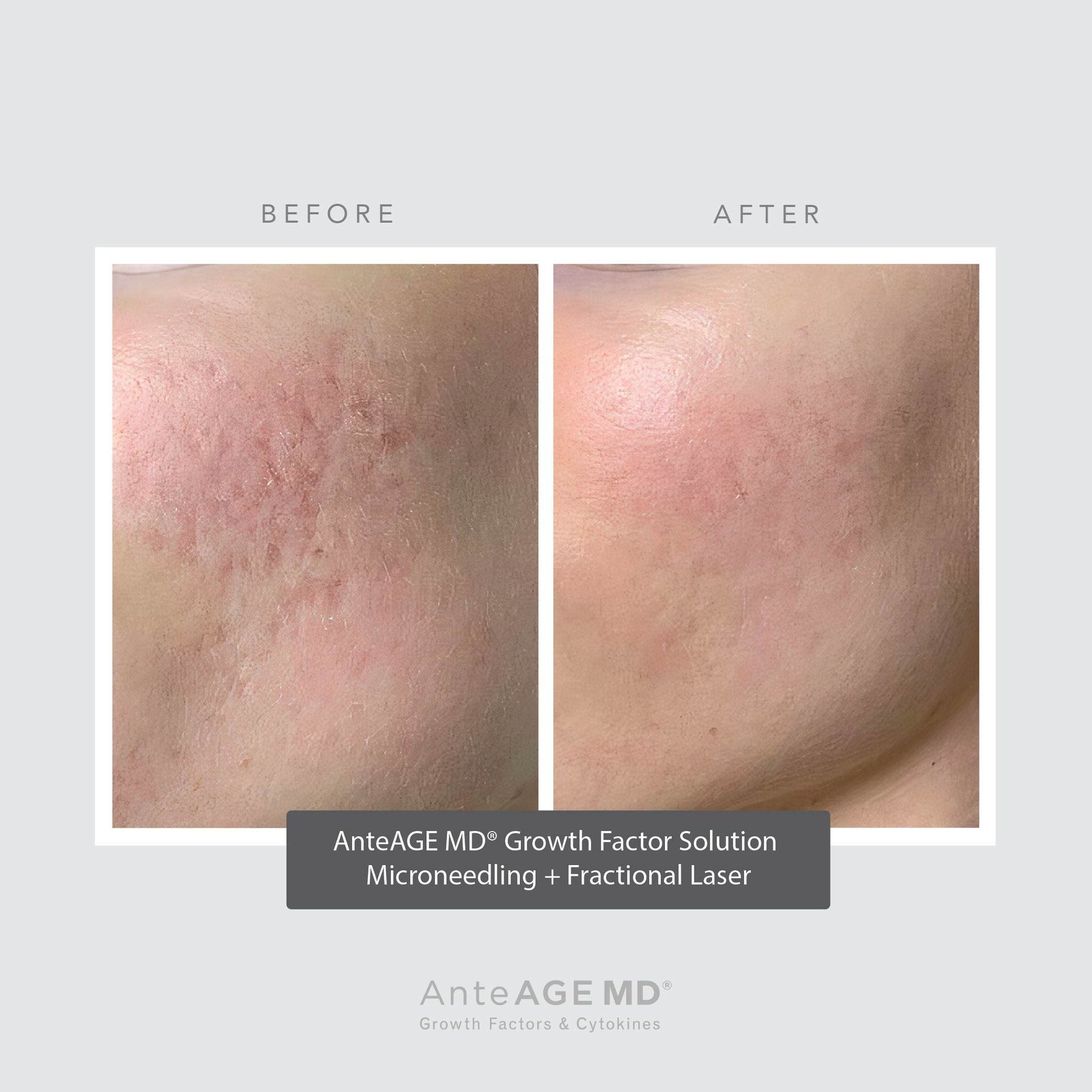 real patient shown before and after treatment with AnteAGE®