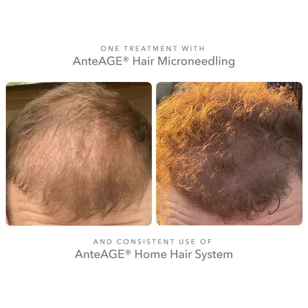 hair loss - microneedling - before and after photos