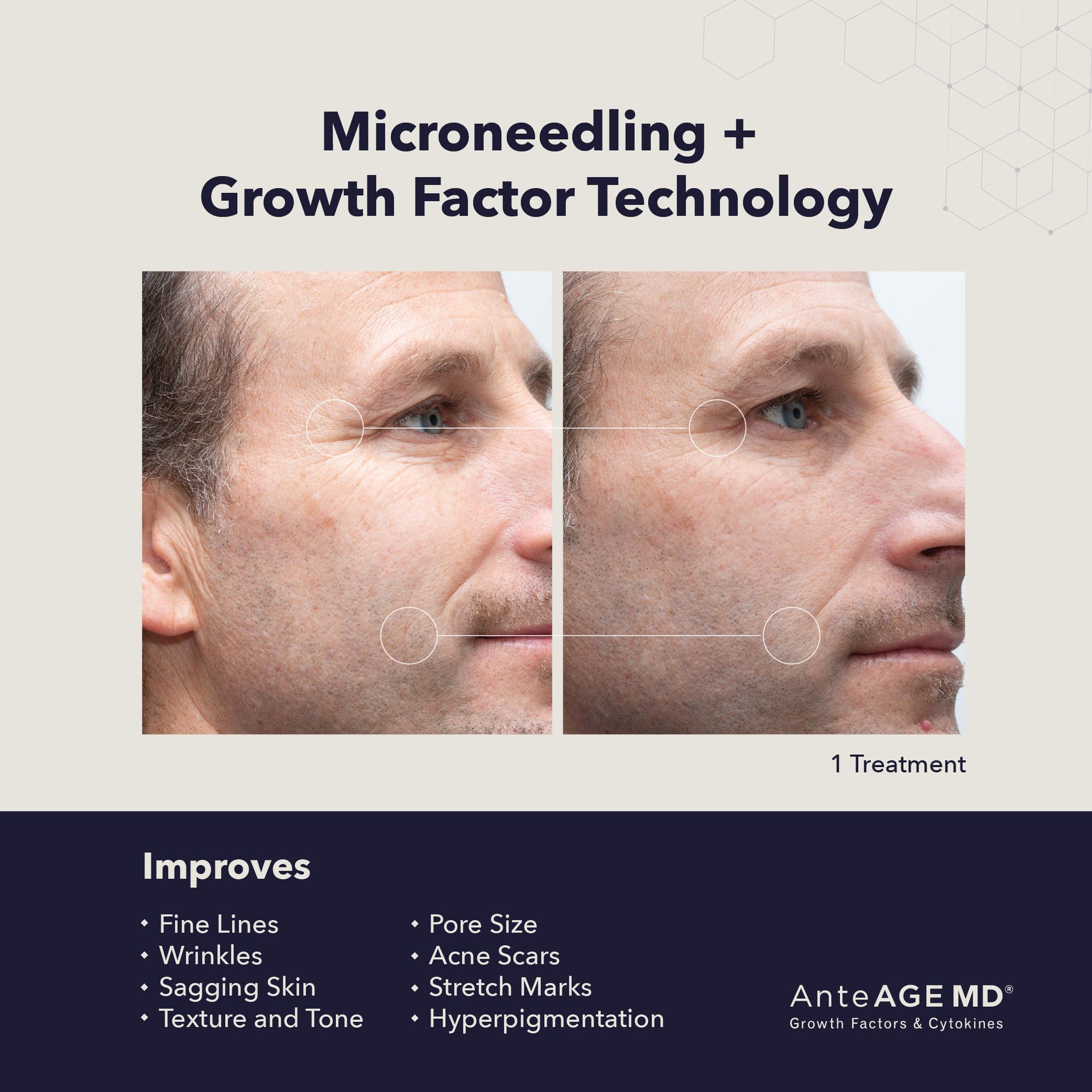 Microneedling using growth factor - before and after photos