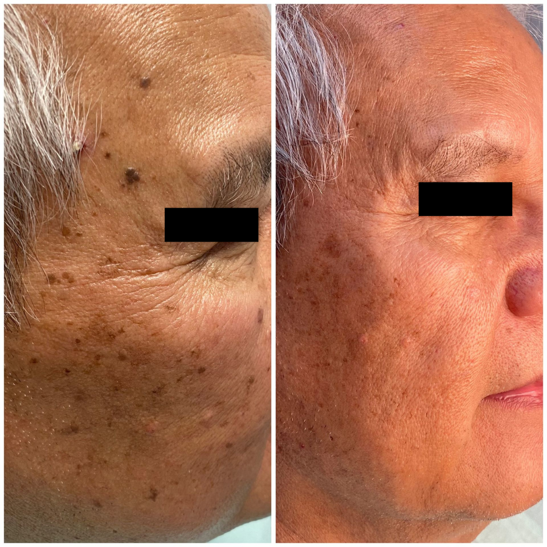 patient photo - BENIGN SKIN LESION REMOVAL