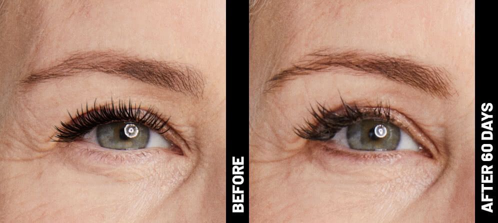ultrasound skin tightening - eyes - before and after photos