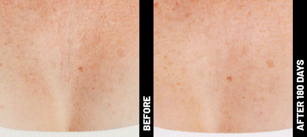ultrasound skin tightening - decolletage - before and after photos