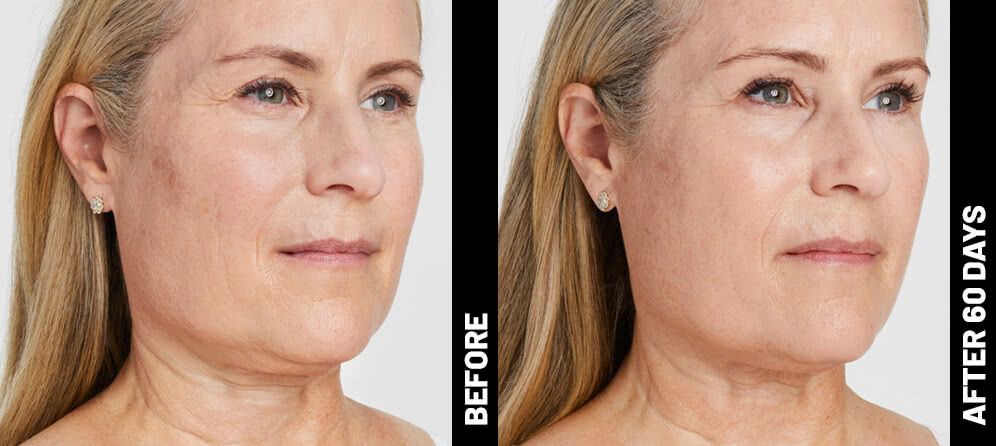 ultrasound skin tightening - face - before and after photos
