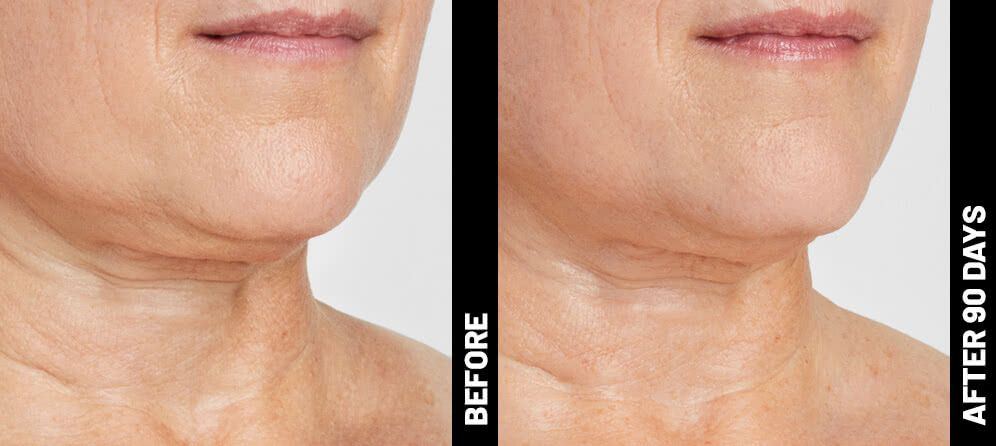 real patient shown before and after treatment with Ultherapy®