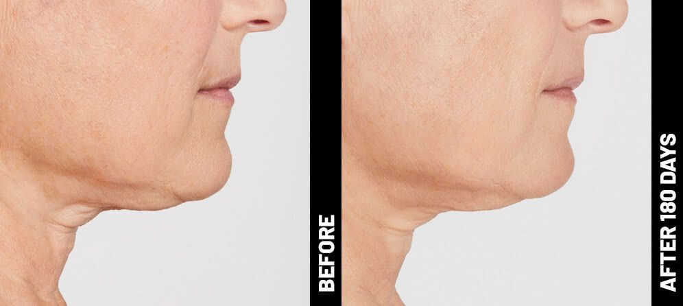 ultrasound skin tightening - neck and under chin - before and after photos