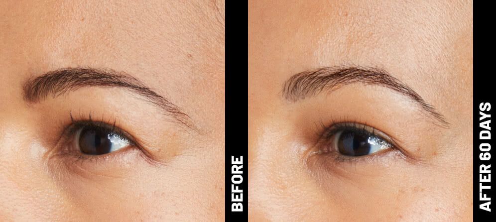 ultrasound skin tightening - eyes - before and after photos