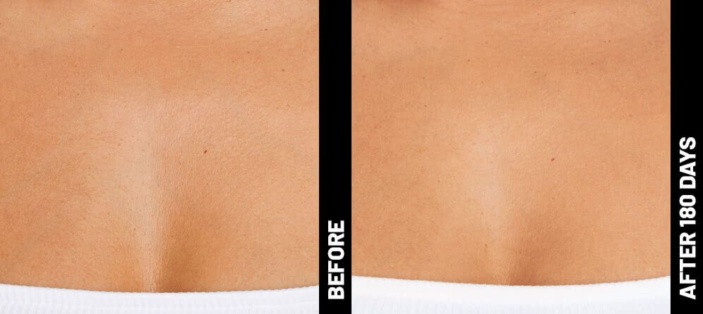 ultrasound skin tightening - decolletage  - before and after photos