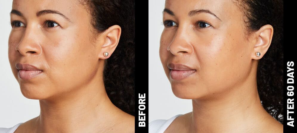 skin tightening lift with ultrasound - before and after
