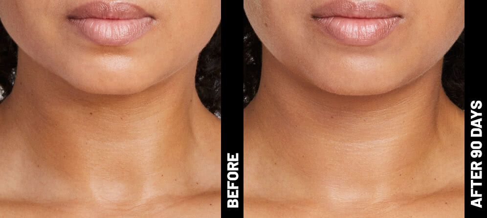 ultrasound skin tightening - neck - before and after photos