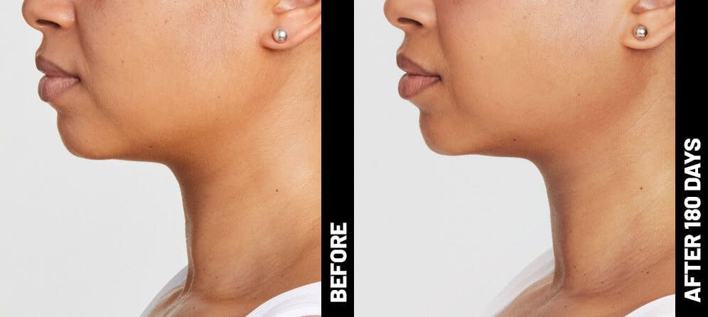 neck lift with ultrasound - before and after photos
