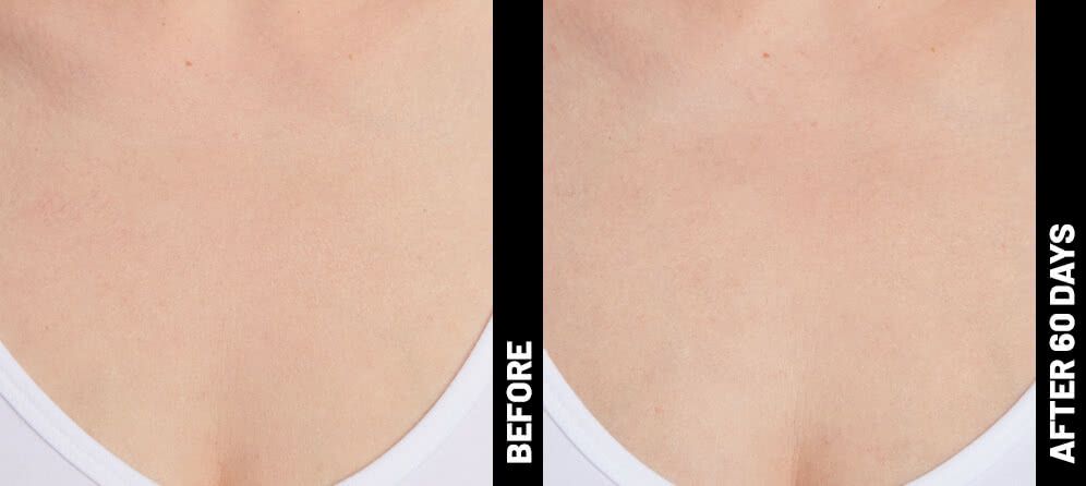 skin tightening in decolletage area - before and after photos
