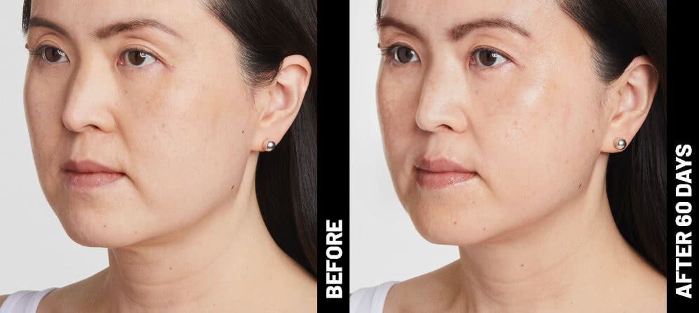 skin tightening using ultrasound - before and after photos